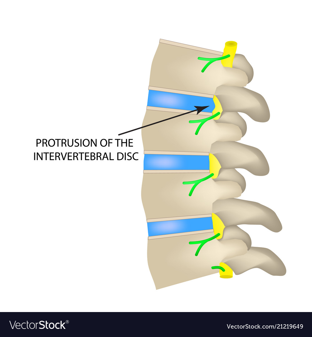 Protrusion of the intervertebral disc