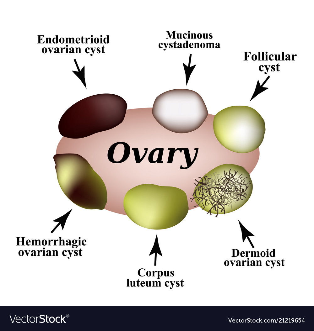 image of different kinds of cysts