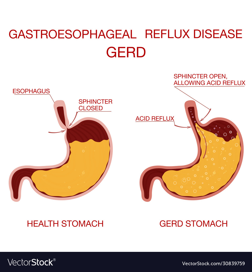 Heartburn and gastroesophageal reflux disease gerd