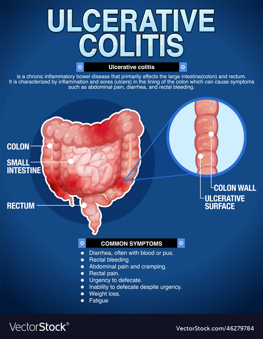 Ulcerative colitis symptoms infographic Royalty Free Vector