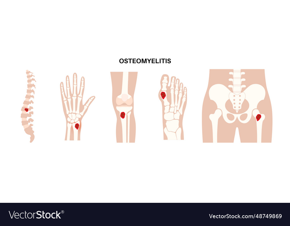 Osteomyelitis disease poster Royalty Free Vector Image