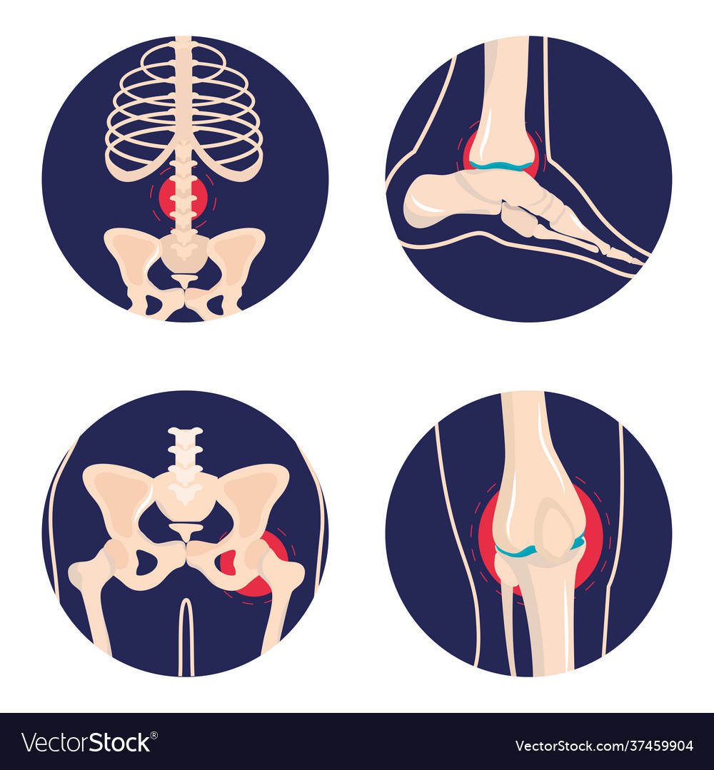 Set arthritis rheumatology