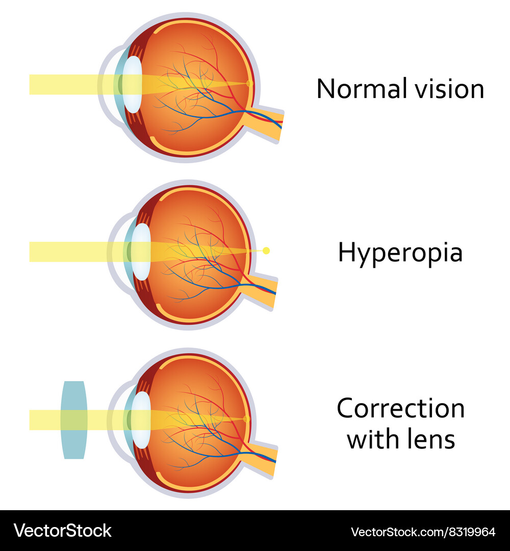 Hyperopia corrected a plus lens Royalty Free Vector Image