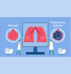 Pulmonary Edema Is Shown Good And Bad Alveoli