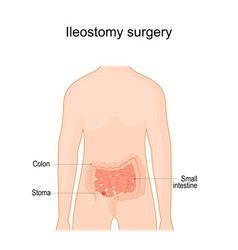 Ileostomy Stoma Surgical Opening Of Small