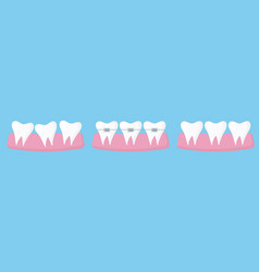 Concept Of Straightening Teeth With Braces