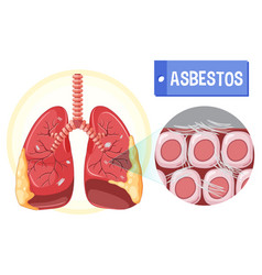 Diagram Showing Asbestosis In Lungs