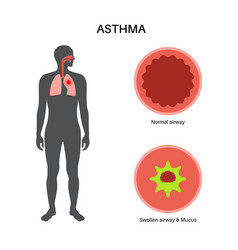 Asthma Lung Disease