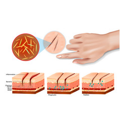 Tissue Injury And Inflammation