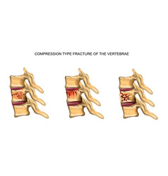 Compression Type Fracture Spine