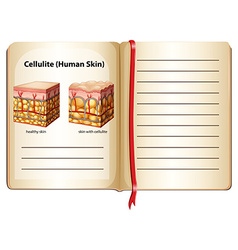 Cellulite Under Human Skin