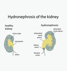 Hydronephrosis And Healthy Kidneys Urology