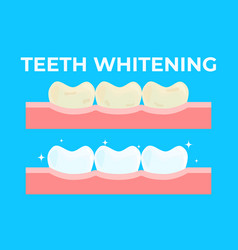 Teeth Whitening Or Bleaching