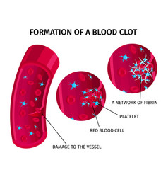 Blood Cells Thrombus Infographics