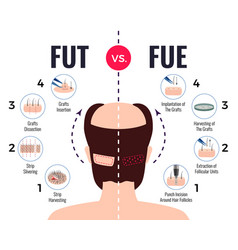 Hair Transplantation Fut Vs Fue