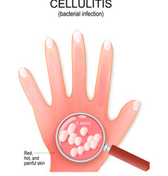 Cellulitis Humans Hand With Bacterial Infection