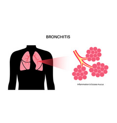 Bronchitis Lung Disease