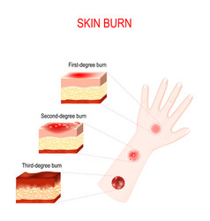 Types Of Burns Cross Section Of Humans Skin