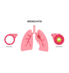 Bronchitis Lung Disease