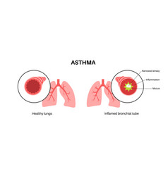 Asthma Lung Disease