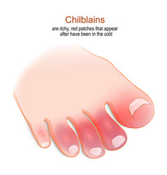 Chilblains Humans Foot With Red Or Swollen Toes