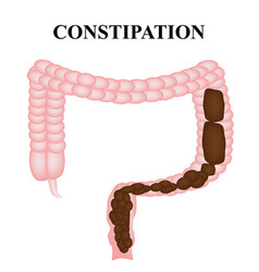 Treatment constipation infographics Royalty Free Vector