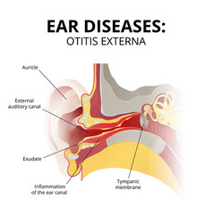 Acute Otitis Externa Sectional Image On White