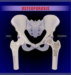 3d Of A Human Hip Bone Comparing The Inside