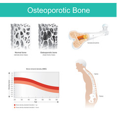 Osteoporotic Bone This Is A Disease In Which