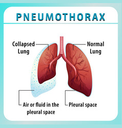 Pneumothorax Diagram With Collapsed Lung