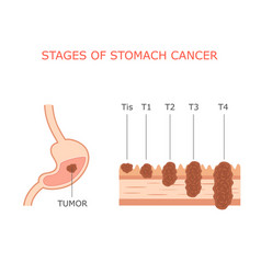 Stomach Cancer Stages