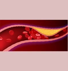 Arteries With Clogged Fat That Causes Blood Clots