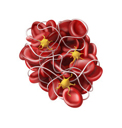 Medicine A Blood Clot Or Thrombus - Coagulation