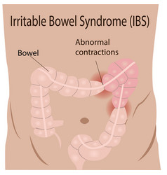 Irritable Bowel Syndrome Ibs In Large Intestine