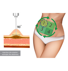 Injection Site Rotation Example Abdomen