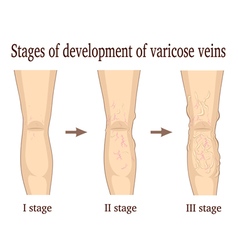 Stages Of Development Of Varicose Veins