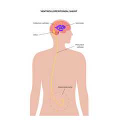 Ventriculoperitoneal Shunt Concept