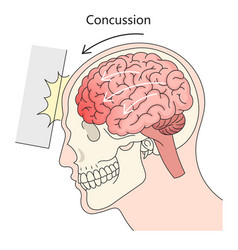 Concussion Structure Diagram Medical Science