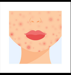 Problem Skin On Female Face Acne Pimples On Chin