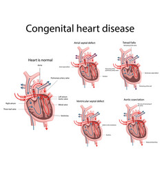 Congenital Heart Disease