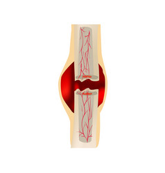 1 Stage Of Healing Bone Fracture Formation