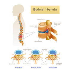 Anatomy Spinal Hernia Infographics