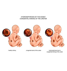 Hydronephrosis Due To Congenital Kinking