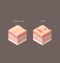 Acne Vulgaris Or Pimple And Normal Skin Cross