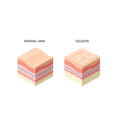 Skin With Cellulite And Normal Cross-section