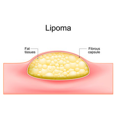 Lipoma Cross Section Of A Human Skin