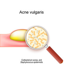 Acne Vulgaris Cross-section Of A Human Skin