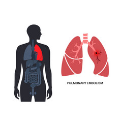 Pulmonary Embolism Disease