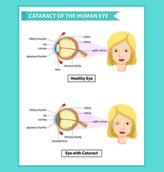 Scientific Medical Cataract Human Eye