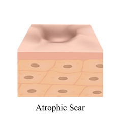 Atrophic Scars Acne Scar The Anatomical